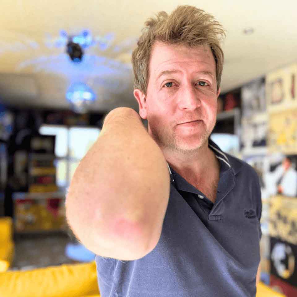A man with short, light brown hair and a navy blue shirt is standing indoors, holding up his left arm, which is amputated above the elbow. The background is a brightly decorated room with yellow furniture.